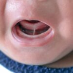 Frénectomie chez les bébés : une histoire de lien à dénouer
