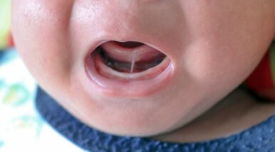 Frénectomie chez les bébés : une histoire de lien à dénouer