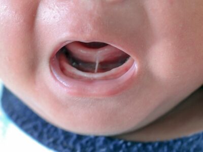 Frénectomie chez les bébés : une histoire de lien à dénouer